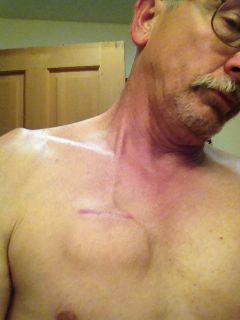 Steve’s IPG “chest pacemaker battery pack sticks out like a pack of cards