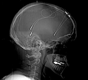 X-Ray image of Broaden Trial participant Steve Ogburn’s DBS implant