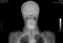 Adverse Effects: The Perils of Deep Brain Stimulation for Depression