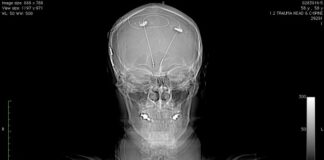 Adverse Effects: The Perils of Deep Brain Stimulation for Depression