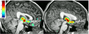 Left: PET Brain scan of patient response to placebo Right: PET Brain scan of patient response to antidepressant