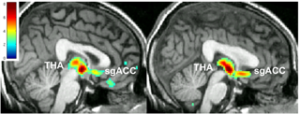 Left: PET Brain scan of patient response to placebo Right: PET Brain scan of patient response to antidepressant 