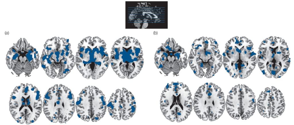 Areas affected in neurological disorders (a) and psychiatric disorders (b). From The British Journal of Psychiatry