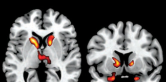 The Hidden Epidemic Exposed: The New Tardive Dyskinesia (TD) Resource Center