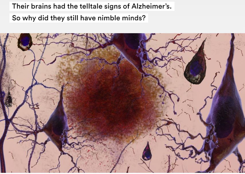 alzheimers