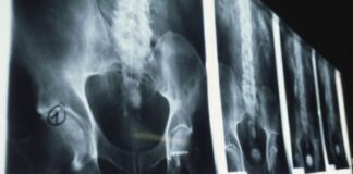 The Long History of Discrimination in Pain Medicine