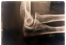 Psychiatric Medications Heighten Risk for Major Bone Fractures