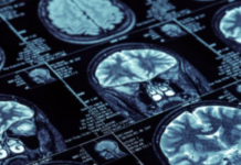 Dementia Patients at Risk of Injury or Death Due to Antipsychotics