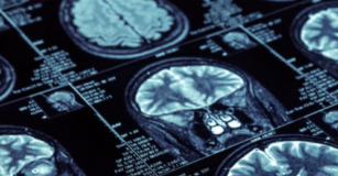 Dementia Patients at Risk of Injury or Death Due to Antipsychotics