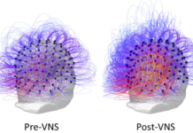 Implant ‘Restores Consciousness’ to Man in Vegetative State