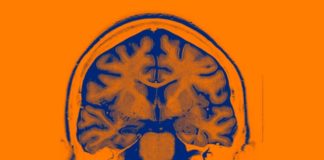 AI-Controlled Brain Implants for Mood Disorders Tested in People