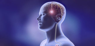 Brain Implants: Spinning the Trial Results to Protect the Product deep brain stimulation