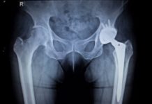The FDA Is Still Letting Doctors Implant Untested Devices Into Our Bodies