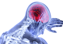 New Study Finds Limited Effectiveness for Antidepressants After Stroke