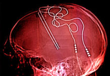 Deep Brain Stimulation and Depression