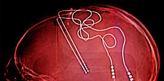 Deep Brain Stimulation and Depression