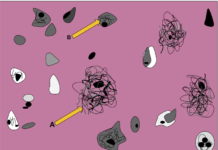 Anticholinergic Drugs Increase Risk of Cognitive Decline