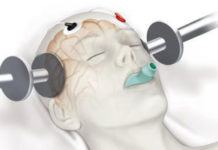 Why Aren’t Patients Being Told Truth About Electric Shock Therapy?