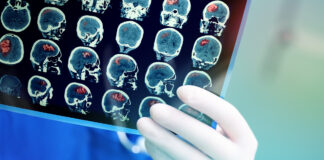 SSRI Antidepressants Do Not Improve Depression After a Stroke Doctor attentively examines the MRI scan of the patient.