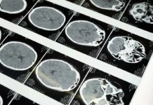 Decades of Alzheimer’s Research Allegedly Based on Fabricated Data