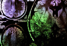 Researchers Find No Brain Differences in Depression Brain scan, mostly purple and black with a big green spot
