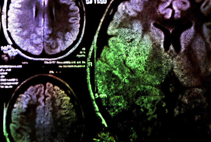 Exploración del cerebro, en su mayoría de color púrpura y negro con una gran mancha verde