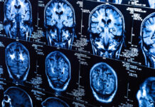 A Neuroscientist Evaluates the Standard Biological Model of Depression A set of brain scans in blue on black backgrounds