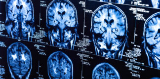A Neuroscientist Evaluates the Standard Biological Model of Depression A set of brain scans in blue on black backgrounds