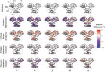 SSRI Use During Pregnancy Alters the Childās Brain Development