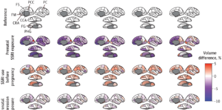 SSRI Use During Pregnancy Alters the Child’s Brain Development